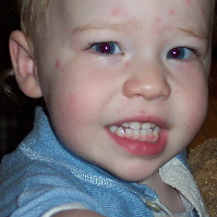 Zachary with spots
